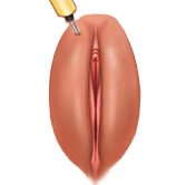 Fat transfer to labia majora